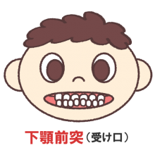 反対咬合（受け口）